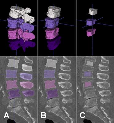 Opportunistic Osteoporosis Screening Reveals Low Bone Density in Patients With Screw Loosening After Lumbar Semi-Rigid Instrumentation: A Case-Control Study